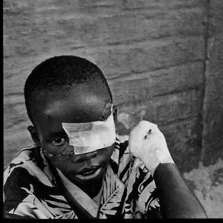 Révérien Rurangwa as a boy, shortly after the Mugina massacre, with bandages over his wounded eye and hand.